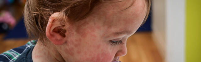 Child dies of horrifying measles complication in Los Angeles