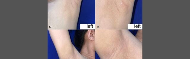 Woman With Rare Condition Has Armpits That Leak Milk