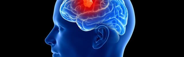 3 People Have Gotten Cancer-Detecting Implants in Their Brains