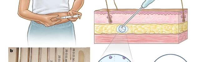 New Birth Control Shot Transforms Into a Long-Lasting Implant—No Clinic Required