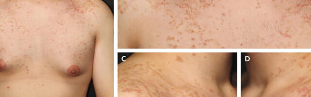 A weird, itchy rash is linked to the keto diet—but no one knows why