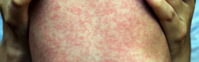 Measles Is Rampaging Through Rural Texas: Dozens Sick, Hundreds Feared Infected