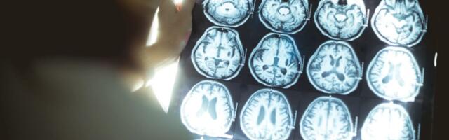 Youngest UK Dementia Case Dies at 24