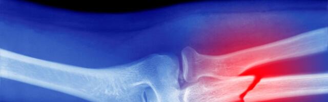 Microplastics Could Be Weakening Your Bones, Research Suggests