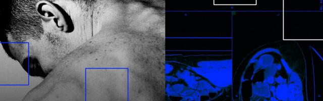 What causes early-onset colon cancer? New research offers clues