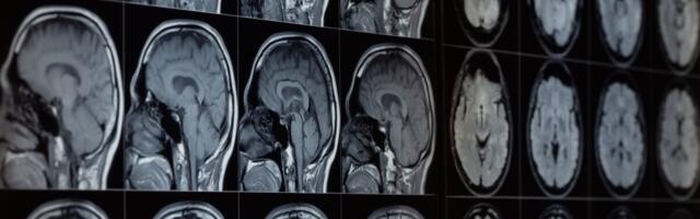 Our Brains Contain Lithium—and Its Loss Might Help Drive Alzheimer’s, Study Finds
