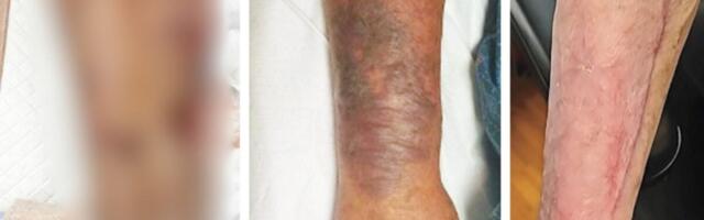 This Is What a Leg Ravaged by ‘Flesh-Eating’ Bacteria Looks Like
