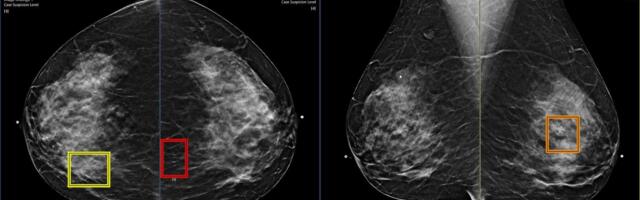 AI Is Detecting More Breast Cancer Cases, Study Suggests