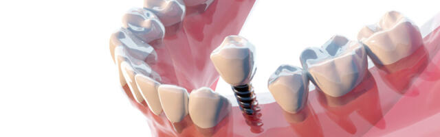 A new dental scam is to pull healthy teeth to sell you expensive fake ones