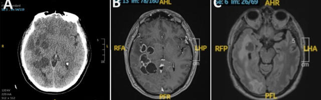 Doctors suspected man had brain cancer. He actually had worms.