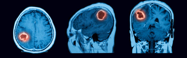 Quantum Brain Sensors Have The Potential To Identify Brain Diseases