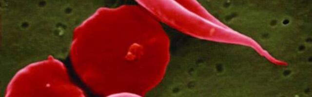 FDA approves first CRISPR gene editing treatment that may cure sickle cell disease