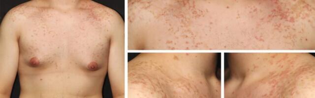 Man’s Switch to Keto Diet Triggers Bizarre, Rare Rash