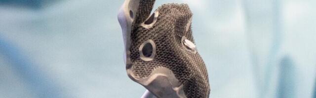 The Doctors Performed a Surgery with the Use of a Locally-Produced Titanium 3D Printed Implant in Samara, Russia