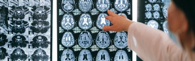 Brain tumour medtech startup gets £860k Innovate UK boost