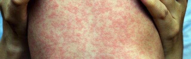Measles Outbreak in South Carolina Linked to Brain Swelling in Kids
