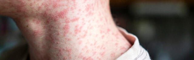 Over 250 people quarantined in South Carolina as measles outbreak rages
