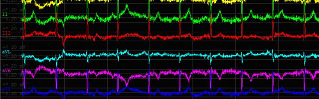 Разработка конвертера формата кардиограммы ECG в формат EDF