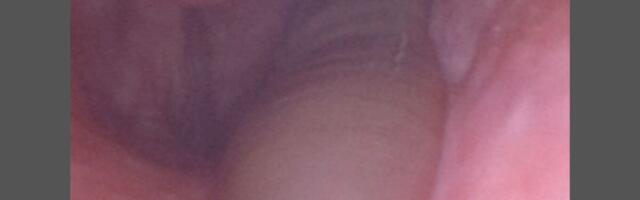 A Refreshing Mountain Rinse Left This Man With a Nose Leech and Days of Bleeding