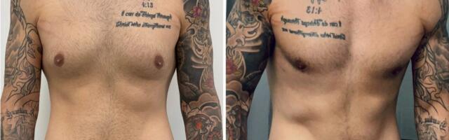 Men get cosmetic surgery, too. I spent $14,000 on plastic surgery, and I don't regret it.
