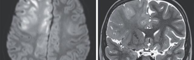 This Is What a Brain Destroyed by Measles Looks Like