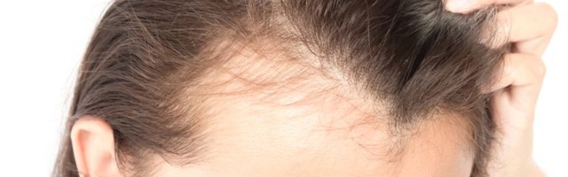 WONDERING WHAT HAIR RESTORATION TECHNIQUE IS RIGHT FOR YOU?