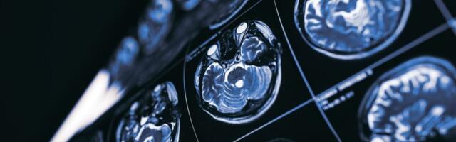 The Newest Alzheimer’s Drugs Might Be Worthless, Review Finds