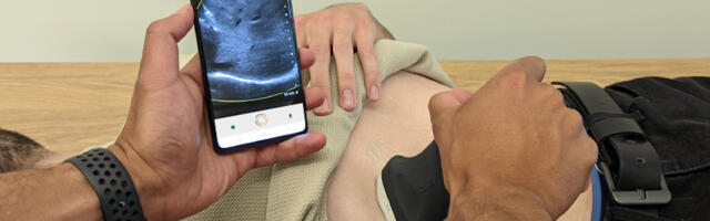 Oncoustics secures $5.5 million CAD to help spot liver disease using AI