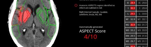 Avicenna.AI collects series A capital for its AI-driven critical radiology screening platform