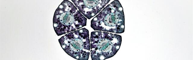 100 Prostate Cancer Patients Treated in Three Radiation Sessions