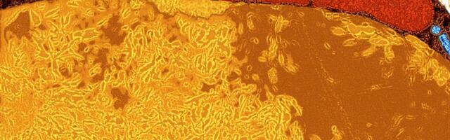 Scientists Uncover an Unlikely New Weapon Against Cancer: Fat Cells