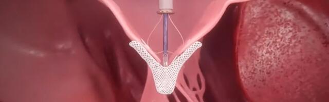 From Dr. Oz to heart valves: A tiny device charted a contentious path through the FDA