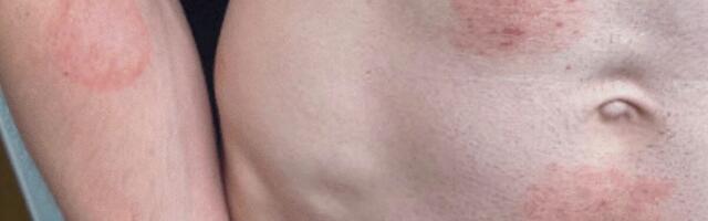 A STI Fungus Is Making Itself Cozy in the US