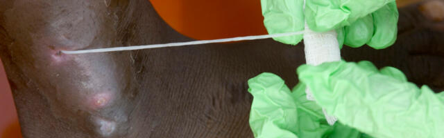 Guinea worm on track to be 2nd eradicated human disease; only 10 cases in 2025