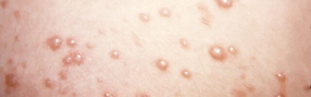 In rare chickenpox case, itchy blisters mushroom into large, rubbery nodules