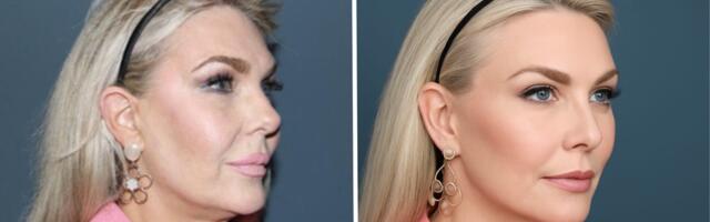 AI face is taking over — and driving plastic surgeons crazy