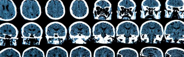 Gene Therapy Slows Huntington’s by 75% in ‘Groundbreaking’ Clinical Trial