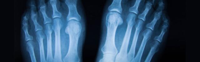 Rare Bone-Eating Cancer Replaced Man’s Finger and Toe