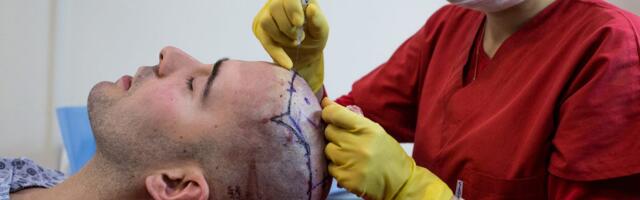 Why hair transplants are so expensive