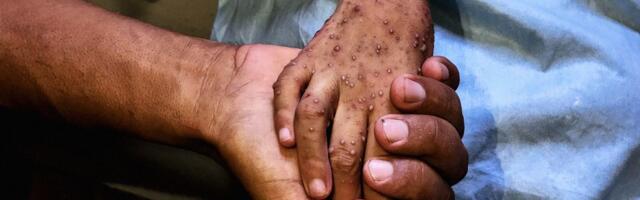 The Grave Long-Term Effects of the Gaza Malnutrition Crisis
