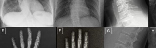 Doctors Struggle to Spot AI-Generated X-Rays, Raising Scam Risks