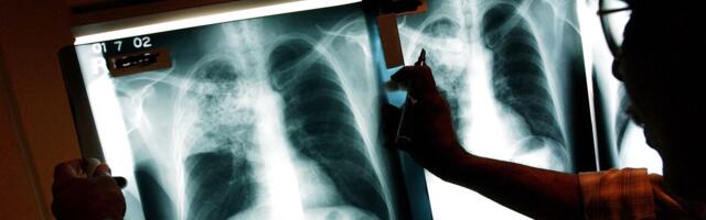 Tuberculosis kills more people than malaria or HIV. Why haven’t we found a vaccine?