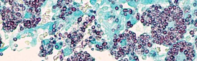 A Rare, Deadly Fungus Is Making People Sick in Tennessee