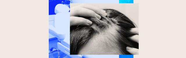 A new laser hair-loss treatment aims to be like going to the dentist twice a year