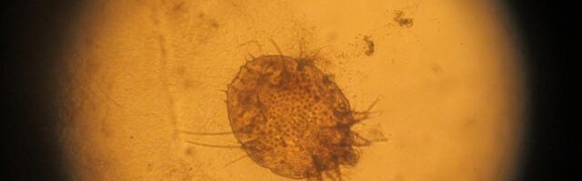 Ask the Pediatrician: What is scabies?