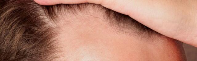 ‘Rogaine’ in a Pill? Oral Minoxidil Aces Major Hair Loss Trial