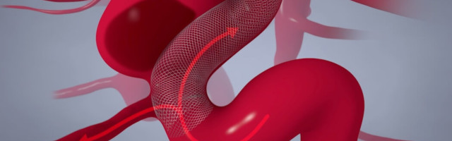 Fluid Biotech secures $5.6 million CAD to accelerate development of innovative brain aneurysm stent