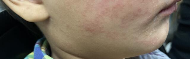 Measles continues raging in South Carolina; 99 new cases since Tuesday