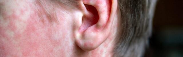 CDC Refuses to Take Blame for Measles Spiraling out of Control