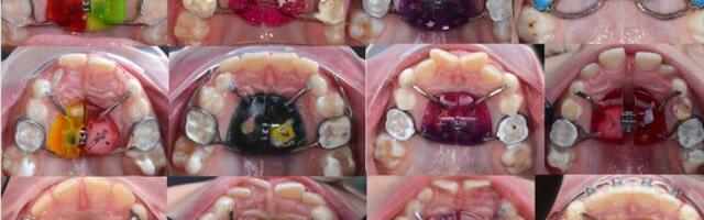 Как мы проектируем и ставим импланты детям в виде божьих коровок, чтобы им лучше дышалось